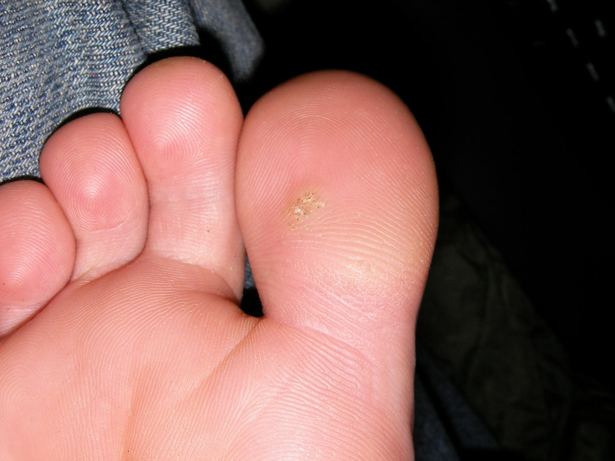 PLANTAR WARTS plantar-warts